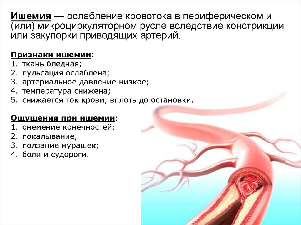 Ишемия сосудов симптомы. Причины и признаки ишемии. Констрикция артерий это. Ишемия пульсация артерий.