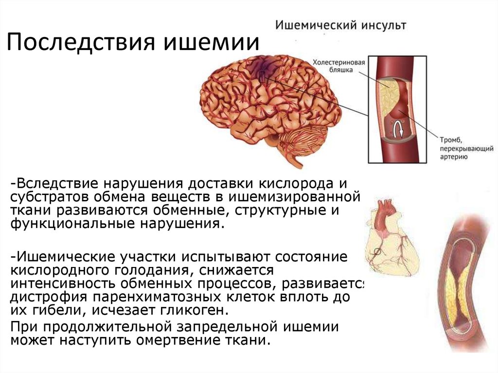 Ишемия осложнения