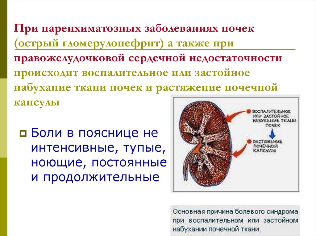 Почечная болезнь. Почка при остром гломерулонефрите. Острые и хронические заболевания почек. Поражение почек при гломерулнефрит.