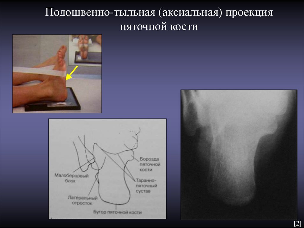 Проекция костей. Пяточная кость в аксиальной проекции на рентгене. Рентген пяточной кости укладка. Рентген пяточной кости в аксиальной проекции. Пяточная кость рентген прямая проекция.