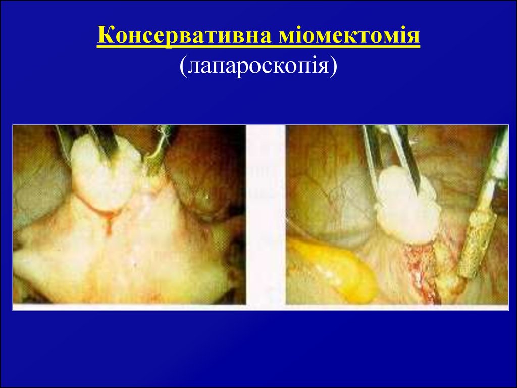 Консервативна міомектомія (лапароскопія)