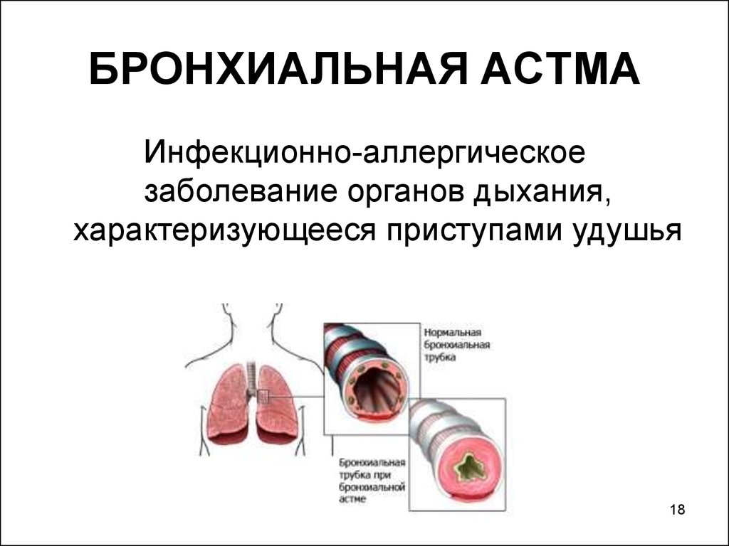 Астма заболевание дыхательных. Заболевания дыхательной системы бронхиальная астма. Бронхиальная астма бронхиальное дыхание. Бронхиальная астма картинки. Воспаление дыхательной системы.