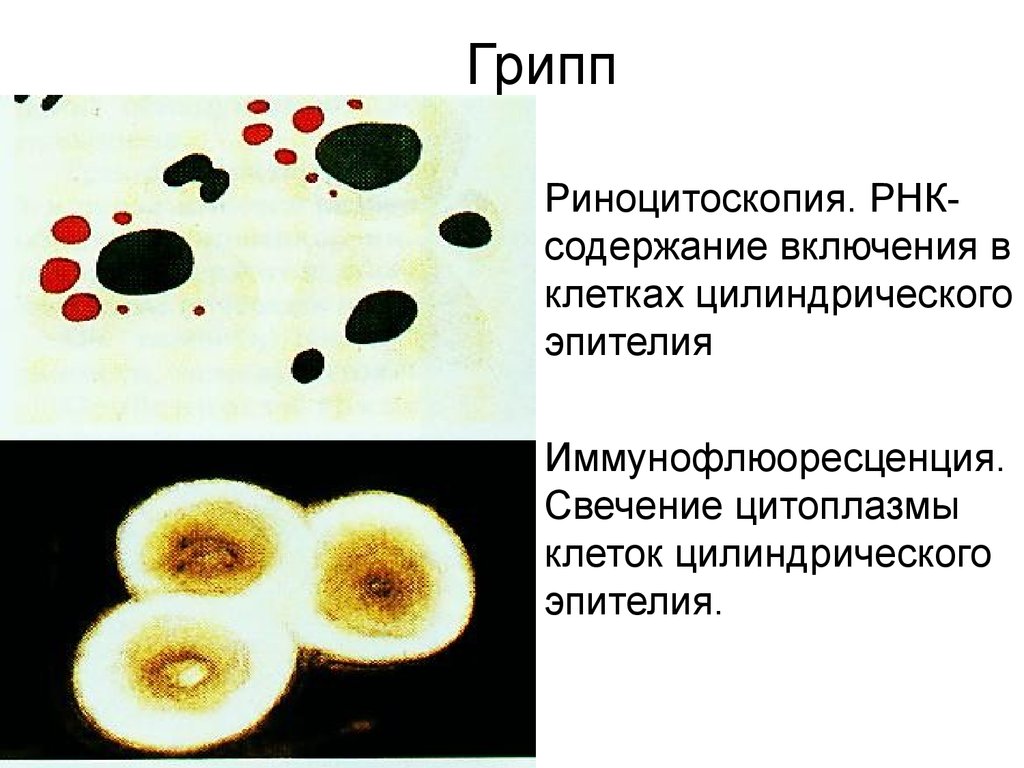 Эритроциты клетки цилиндрического эпителия. Риноцитоскопия. Включения клетки. Цилиндрический эпителий в Кале. Риноцитограмма.