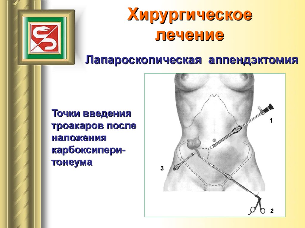 Точки аппендицита