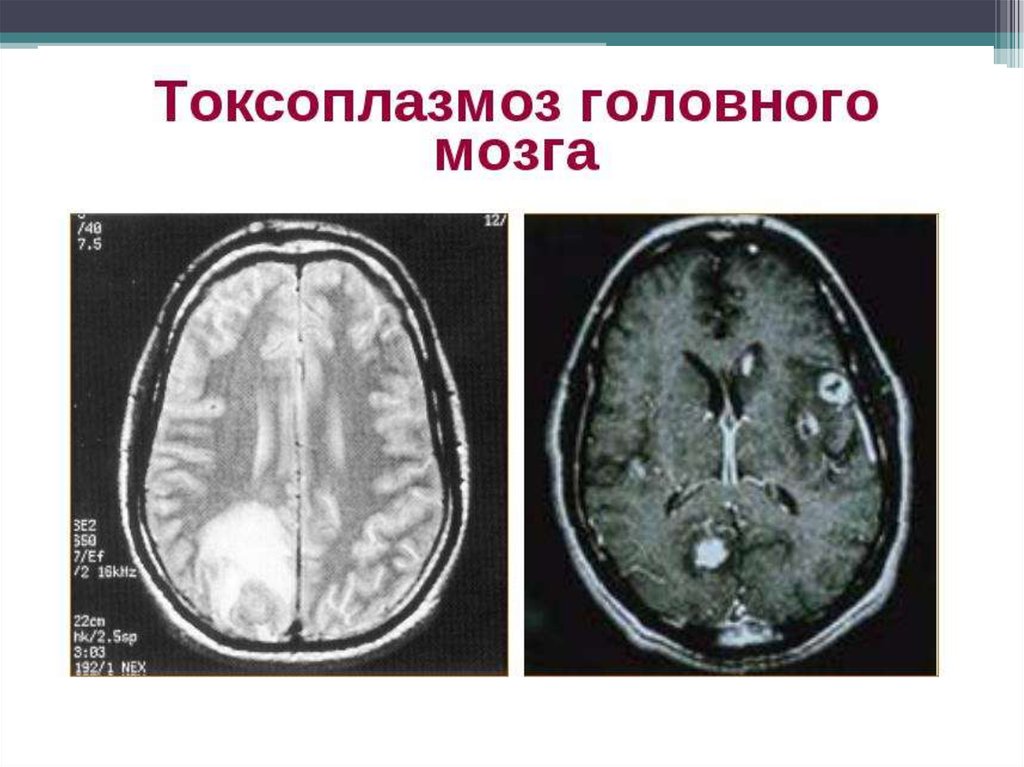 Внутриутробное поражение головного мозга. Токсоплазмоз головного мозга мрт. Токсоплазмоз головного мозга мрт картина. Токсоплазмоз на кт головного мозга. Токсоплазмоз головного мозга кт картина.