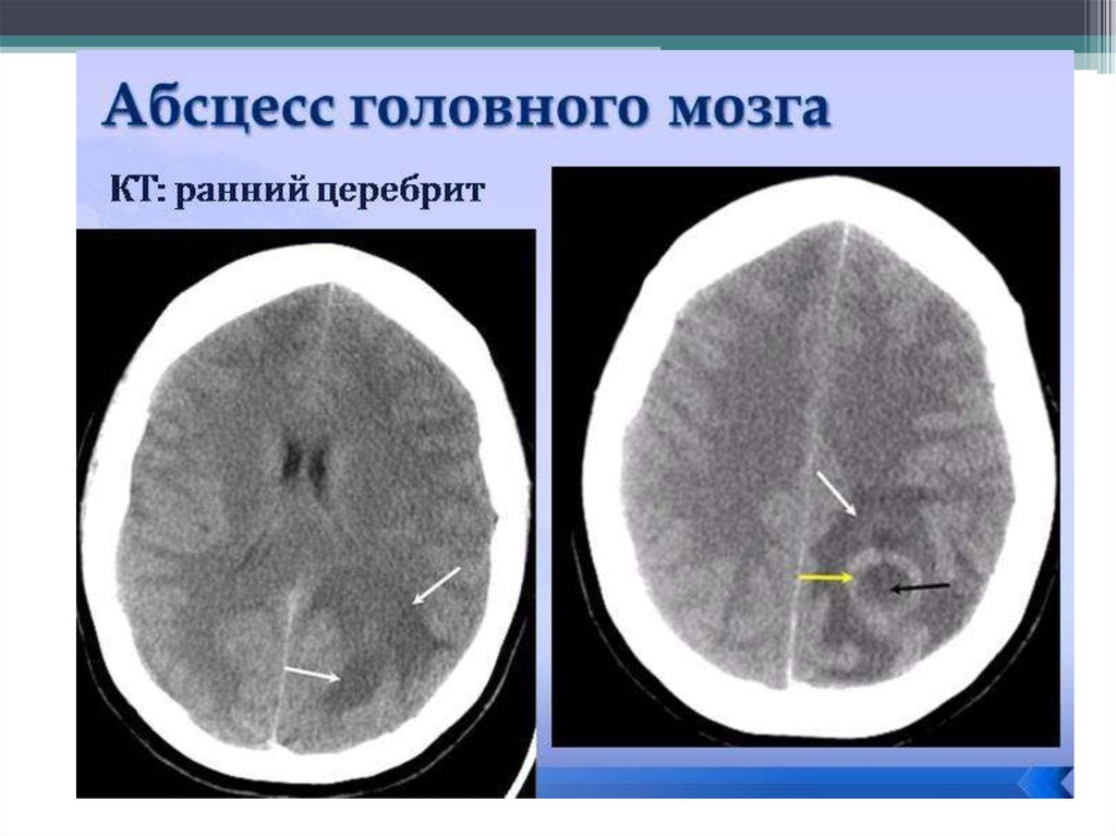 Абсцесс мозга симптомы. Абсцесс лобной доли кт. Токсоплазмоз на кт головного мозга. Кт при абсцессе головного мозга.