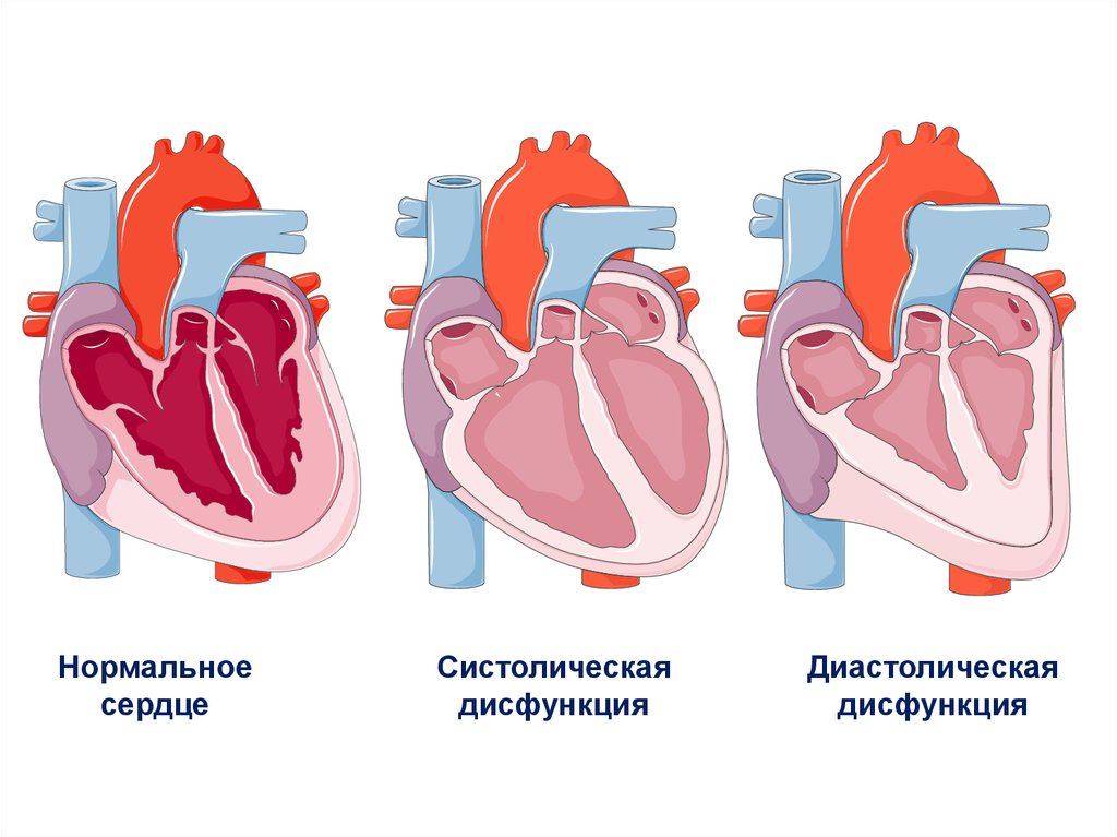 Дисфункции желудочков сердца