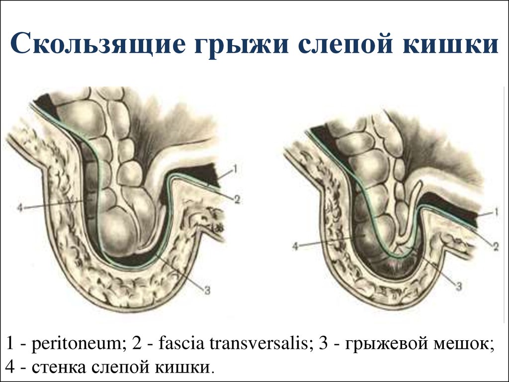 Паховая грыжа рисунок