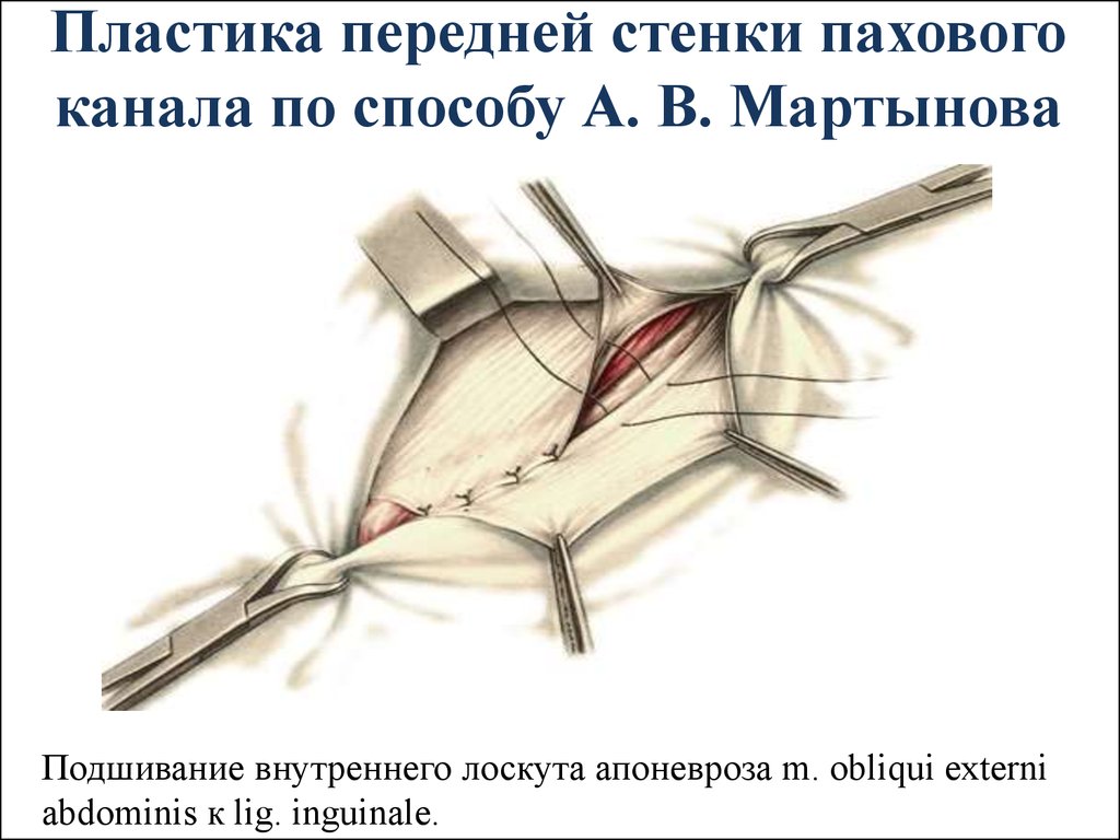 Пластика стенок. Мартынов пластика передней стенки пахового канала. Пластика паховой грыжи по Мартынову. Паховая грыжа операция по Мартынову. Пластика передней стенки по Мартынову.