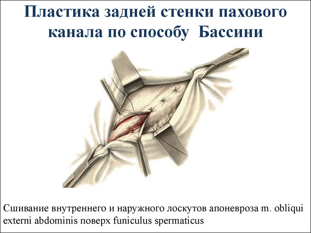 Пластика задней. Пластика задней стенки по Бассини. Пластика пахового канала Бассини. Пластика задней стенки пахового. Пластика передней стенки по Бассини.