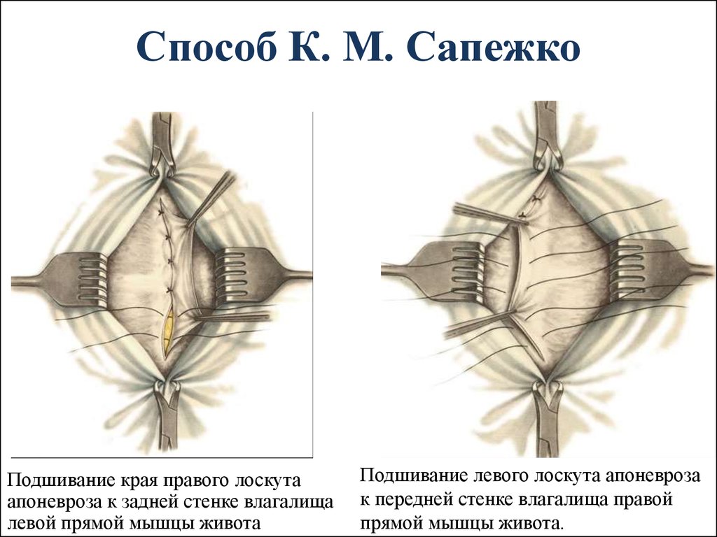 Пластика по мейо картинки