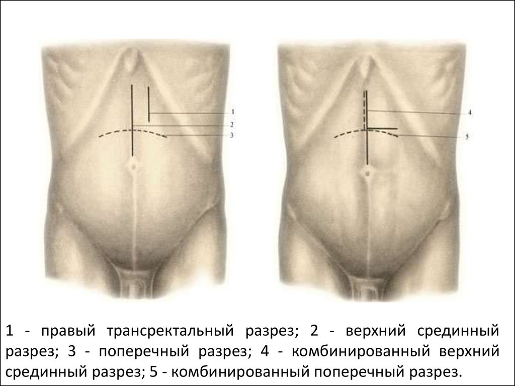 Нижняя лапаротомия. Верхнесрединная лапаротомия показания. Трансректальный разрез брюшной стенки. Нижнесрединная лапаротомия. Супраумбиликальный срединный разрез.