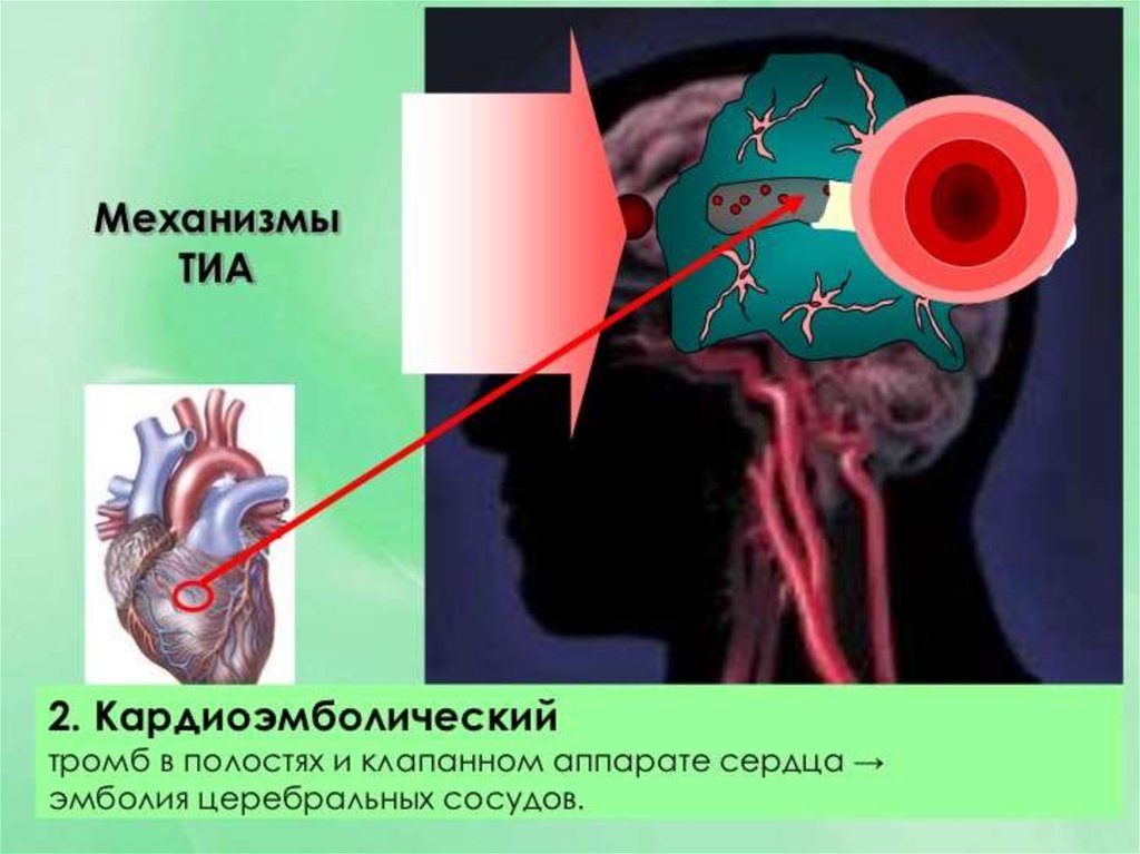 Транзиторная ишемия. Транзиторная ишемическая атака патанатомия. Эмболия мозговых сосудов. Механизм транзиторной ишемической атаки.