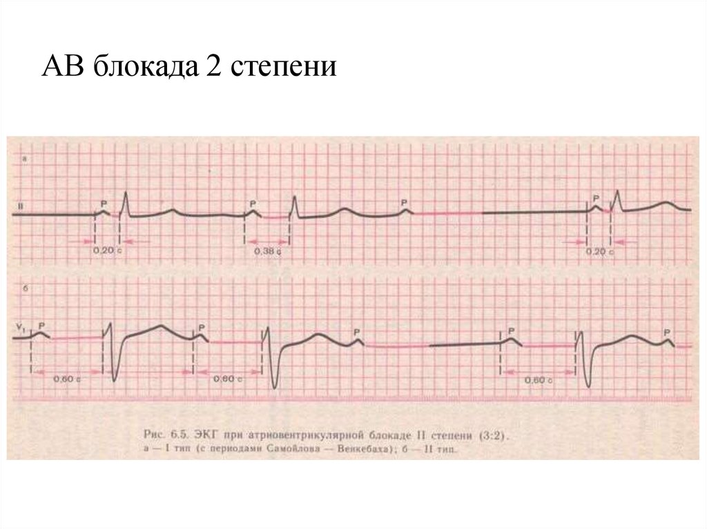 Экг 2. АВ блокада 2 степени Мобитц 2 на ЭКГ. Av блокада Мобитц 2 ЭКГ. АВ блокада 2 степени Мобитц 1 на ЭКГ. Атриовентрикулярная блокада 2 степени Мобитц 2 на ЭКГ.