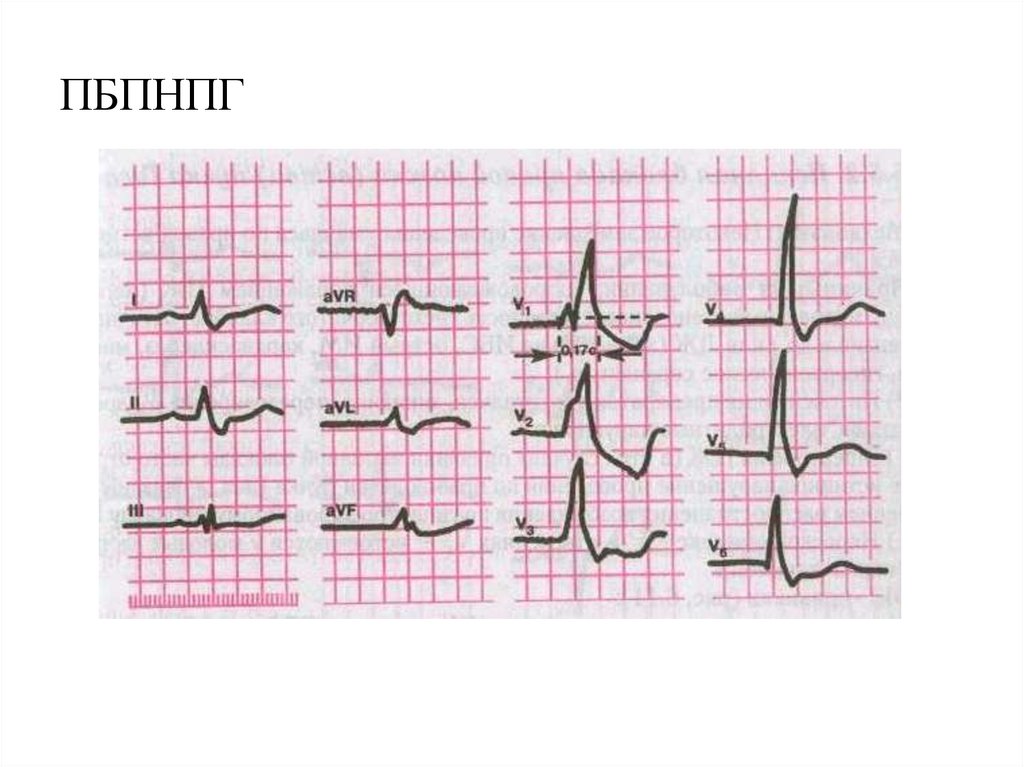 Полная блокада правой ножки пучка гиса. НБПНПГ на ЭКГ. НБПНПГ на ЭКГ что это у ребенка. Сочетание БПВЛНПГ И НБПНПГ на ЭКГ. ПБПНПГ Тэла.