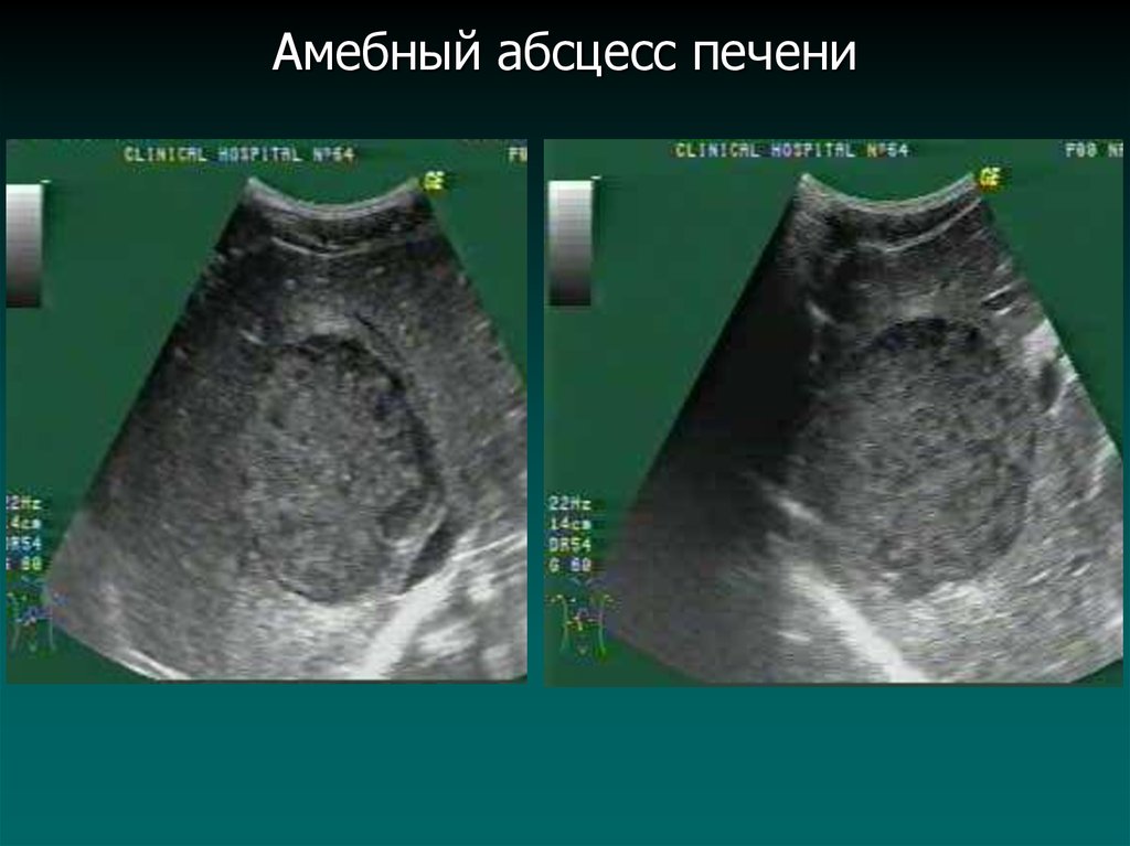 Абсцесс печени. Амебный абсцесс печени клиника. Амебиазный абсцесс печени.