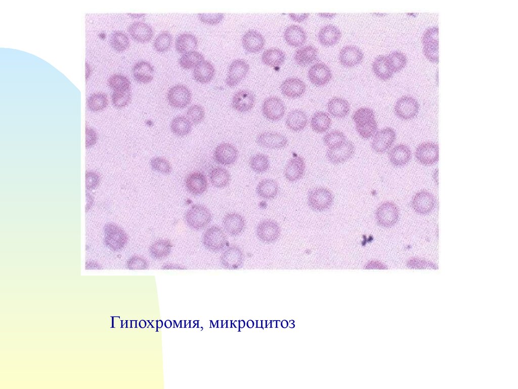 Гипохромия. Гипохромия и микроцитоз эритроцитов. Анемия гипохромия микроцитоз. Микроцитоз при железодефицитной анемии. Гипохромия эритроцитов при железодефицитной анемии.