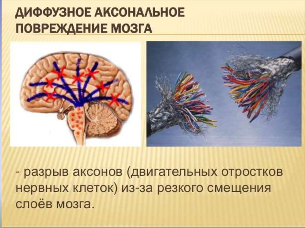 Травматических повреждений мозга. Диффузное аксональное повреждение мозга. Диффузно аксональные повреждения головного мозга клиника. Разрыв аксонов головного мозга. Диффузно аксональная травма головы.