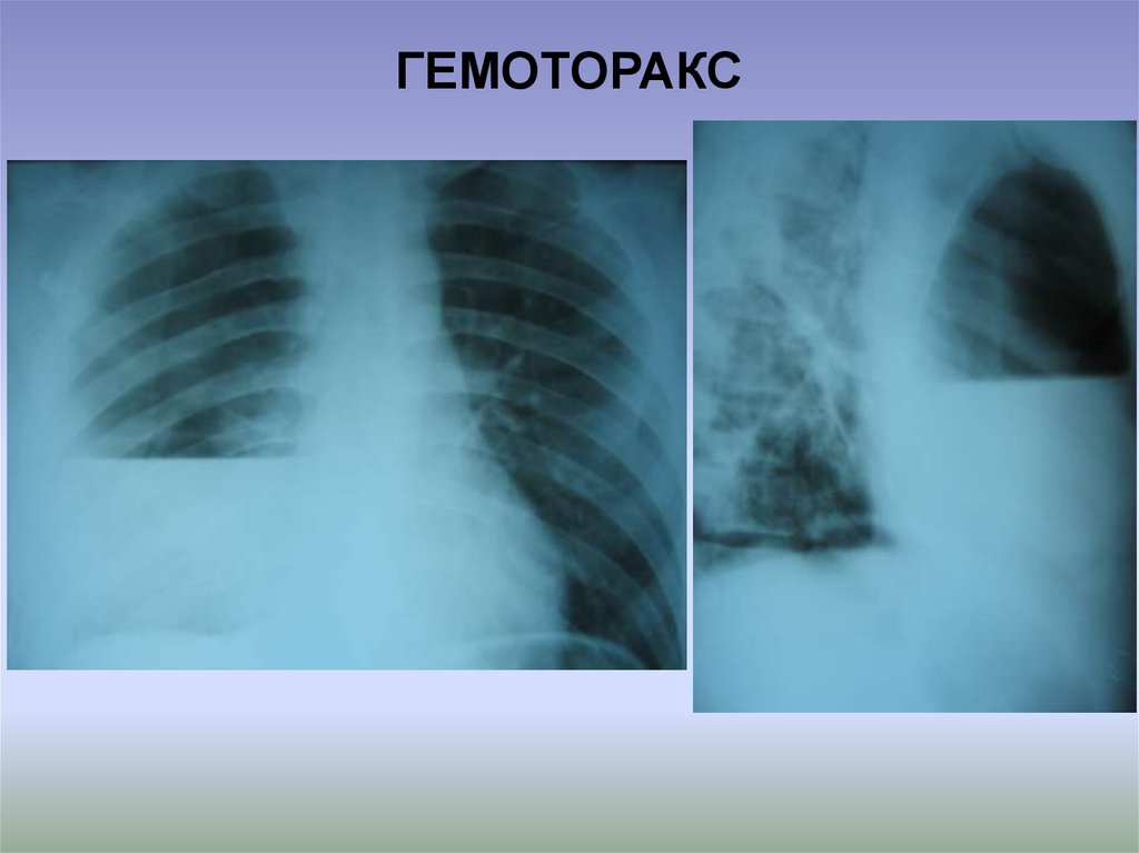 Лучевые признаки гидроторакса гемоторакса рентгеновская картина