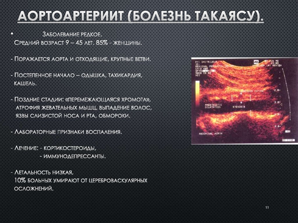 Синдром такаясу презентация