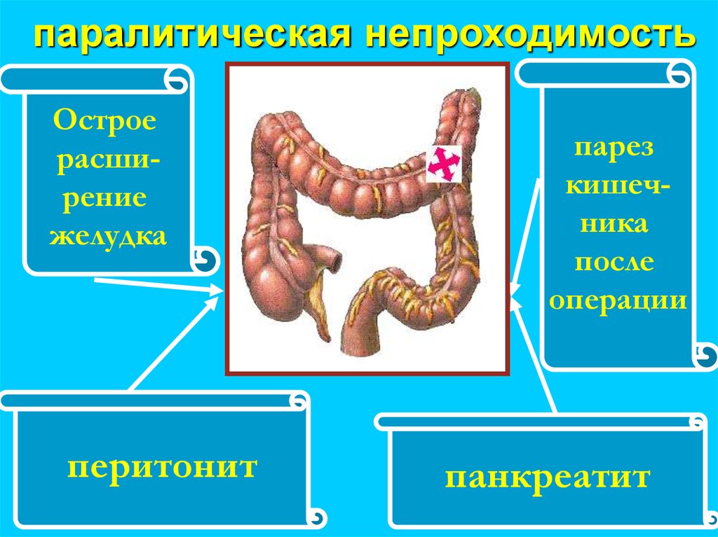 Парез кишечника это. Паралитическая острая кишечная непроходимость. Паралитическая кишечная непроходимость. Парез кишечника и паралитический илеус. Паралитическая непроходимость кишечника.