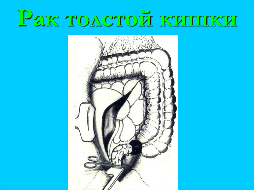 Рак толстой кишки