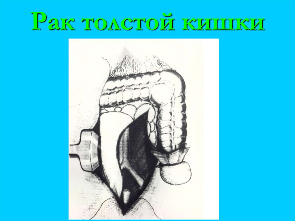 Рак толстой кишки