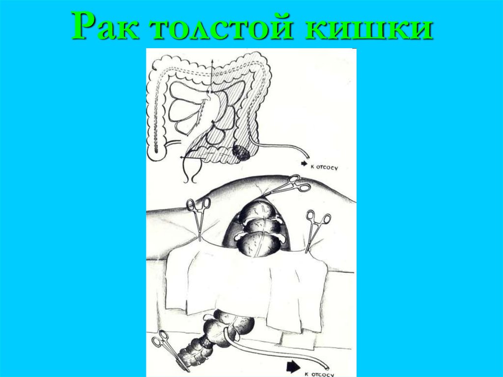 Рак толстой кишки