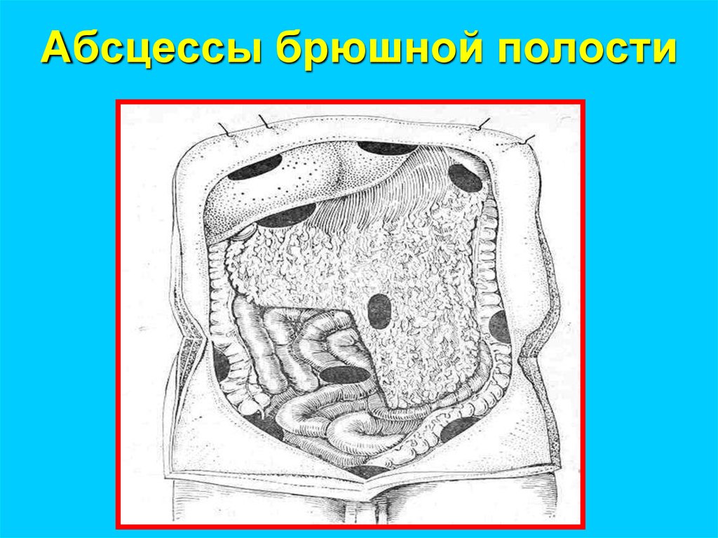 И других органов брюшной полости. Внутрибрюшинные абсцессы.