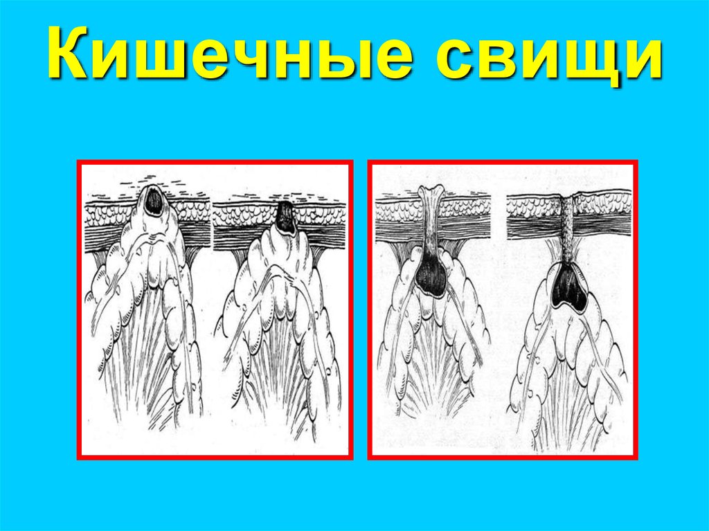 Кишечные свищи презентация госпитальная хирургия