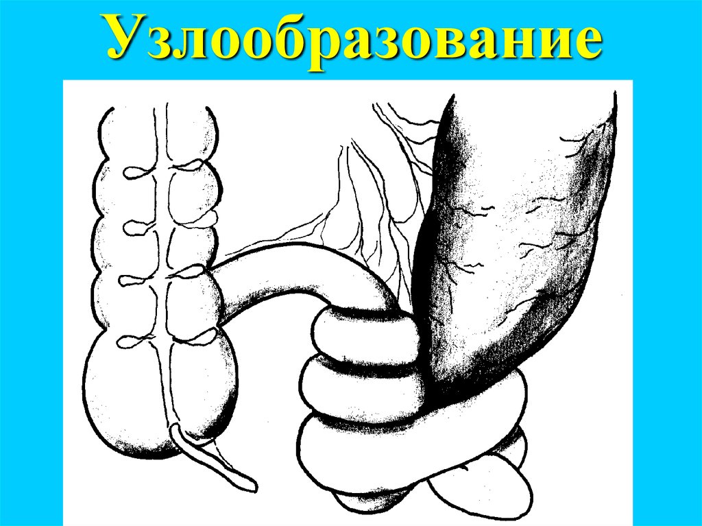 Узлообразование