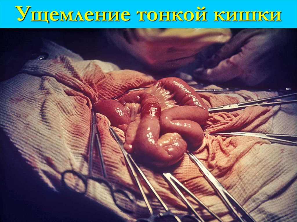 Ущемление тонкой кишки