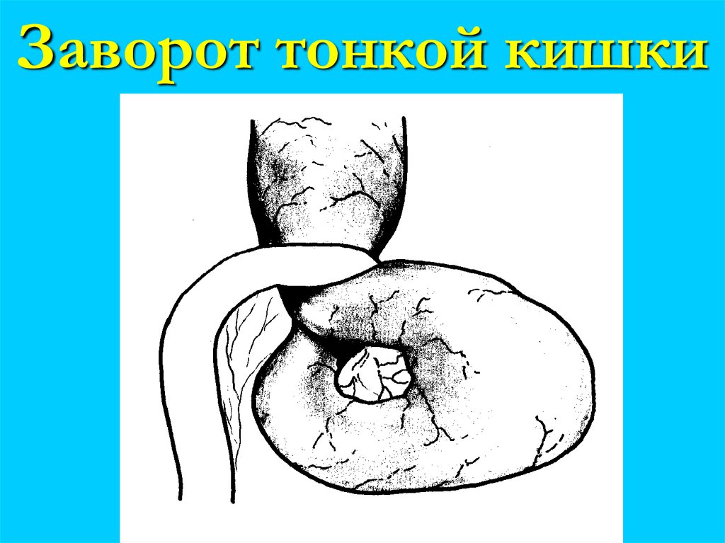 Заворот тонкой кишки