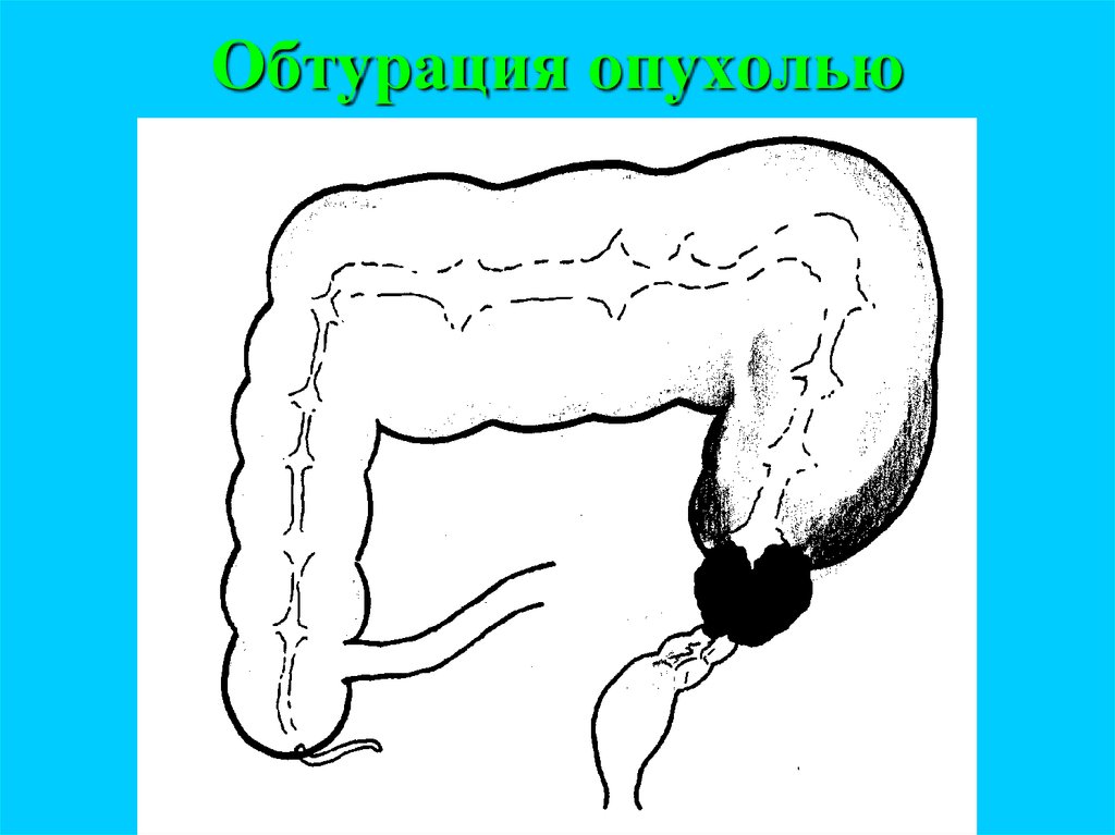 Обтурационная форма рака. Кишечная непроходимость ирригоскопия. Обтурационную кишечной непроходимости. Обтурация кишки опухолью. Обтурационная кишечная непроходимость.