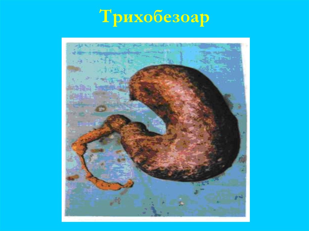 Трихобезоар