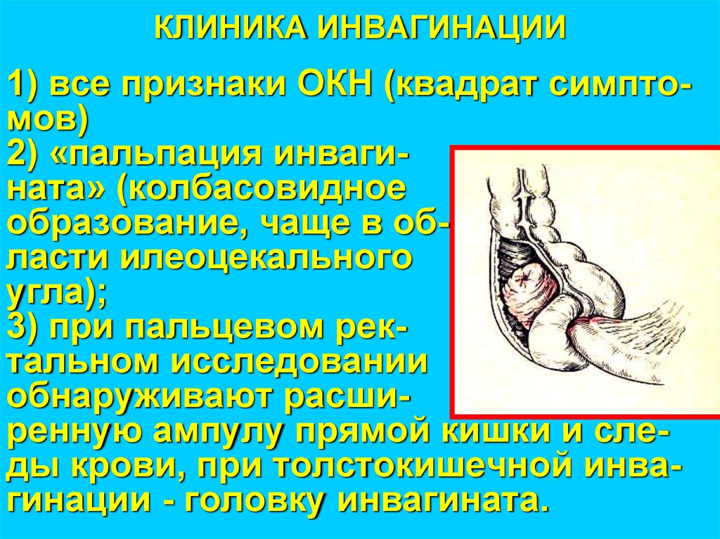 КЛИНИКА ИНВАГИНАЦИИ