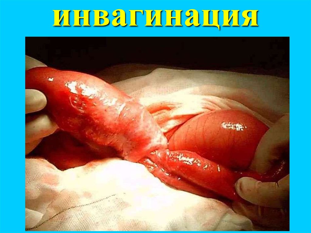инвагинация