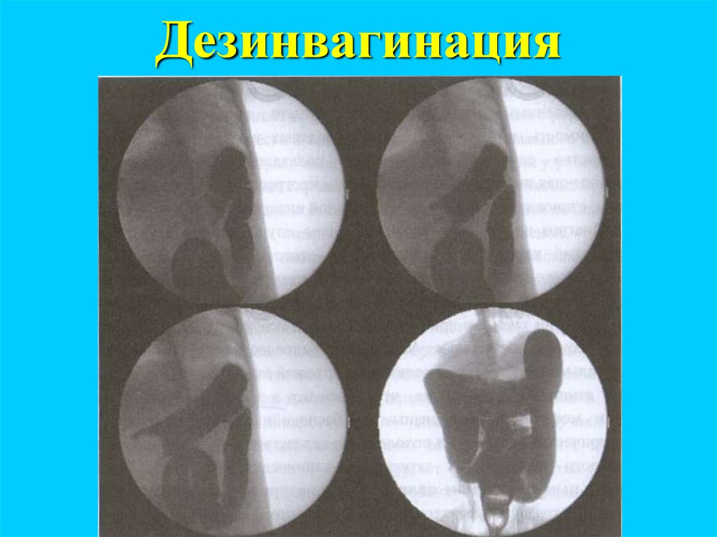 Дезинвагинация