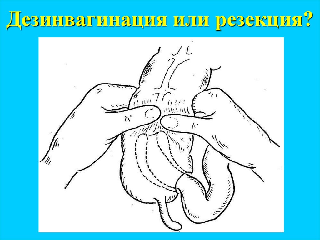 Дезинвагинация или резекция?