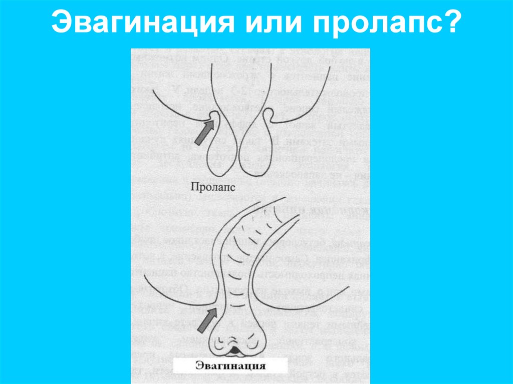 Эвагинация или пролапс?