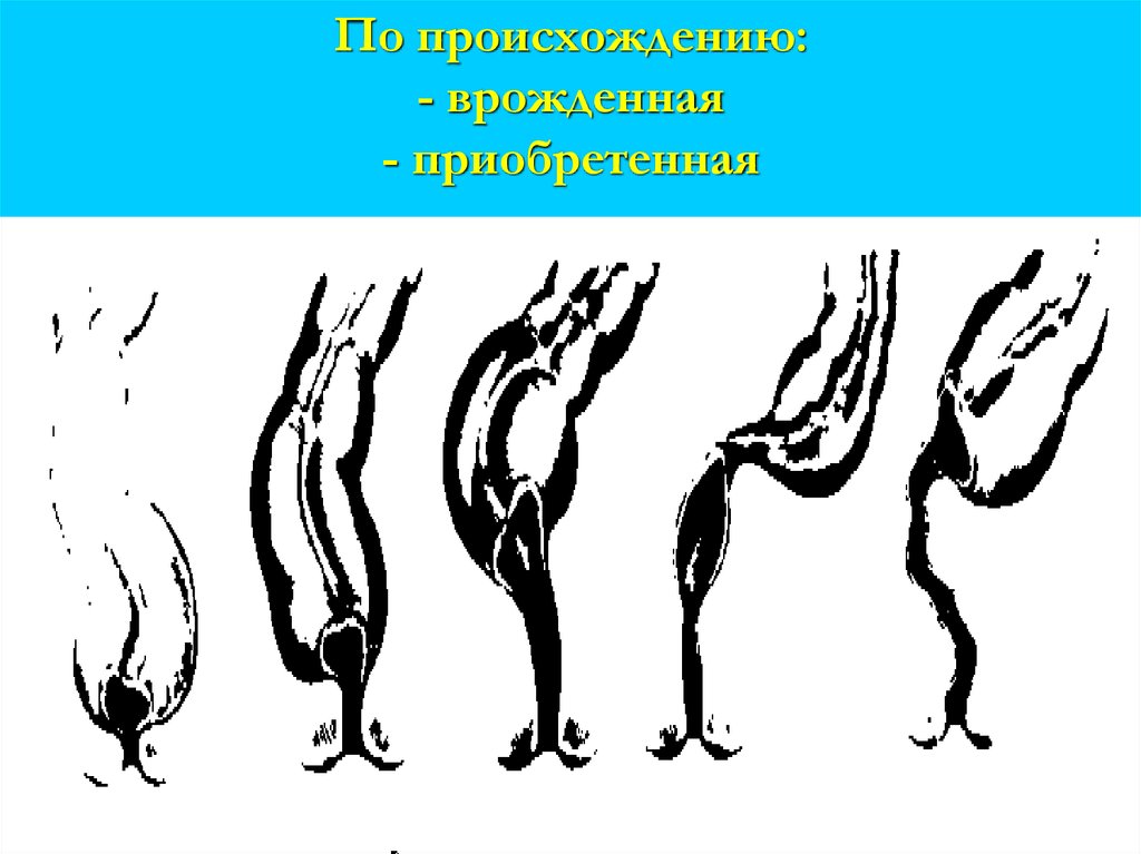 По происхождению: - врожденная - приобретенная