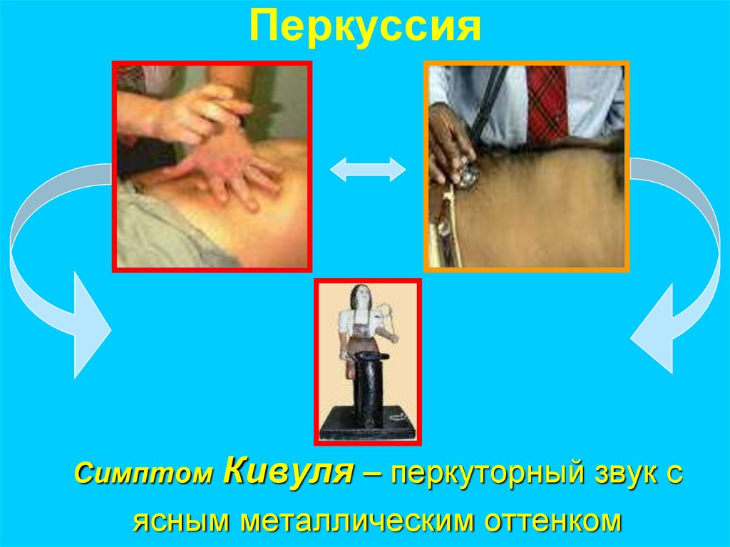 Симптом Кивуля – перкуторный звук с ясным металлическим оттенком