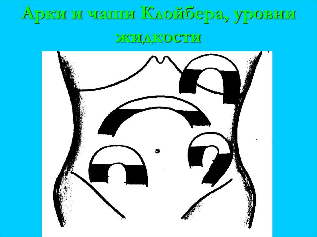 Арки и чаши Клойбера, уровни жидкости