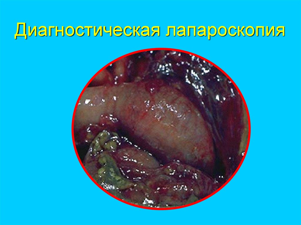 Диагностическая лапароскопия