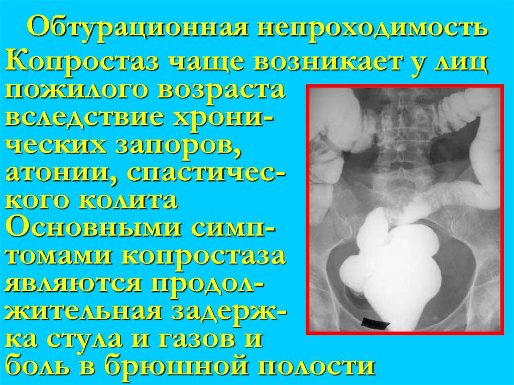 Обтурационная непроходимость