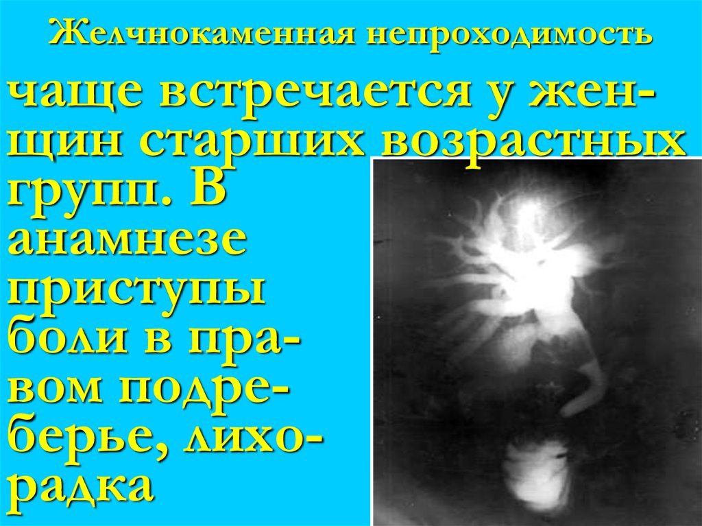 Желчнокаменная непроходимость