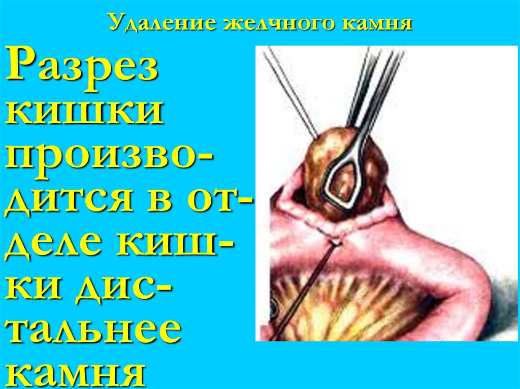 Удаление желчного камня