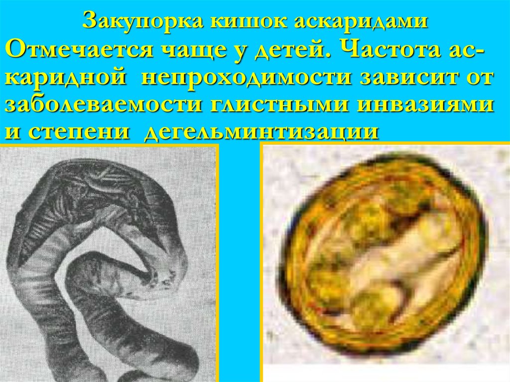 Закупорка кишок аскаридами