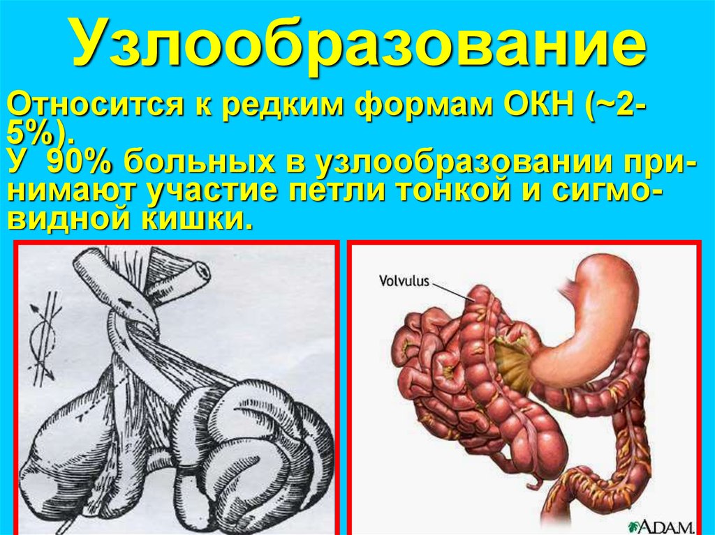 Узлообразование