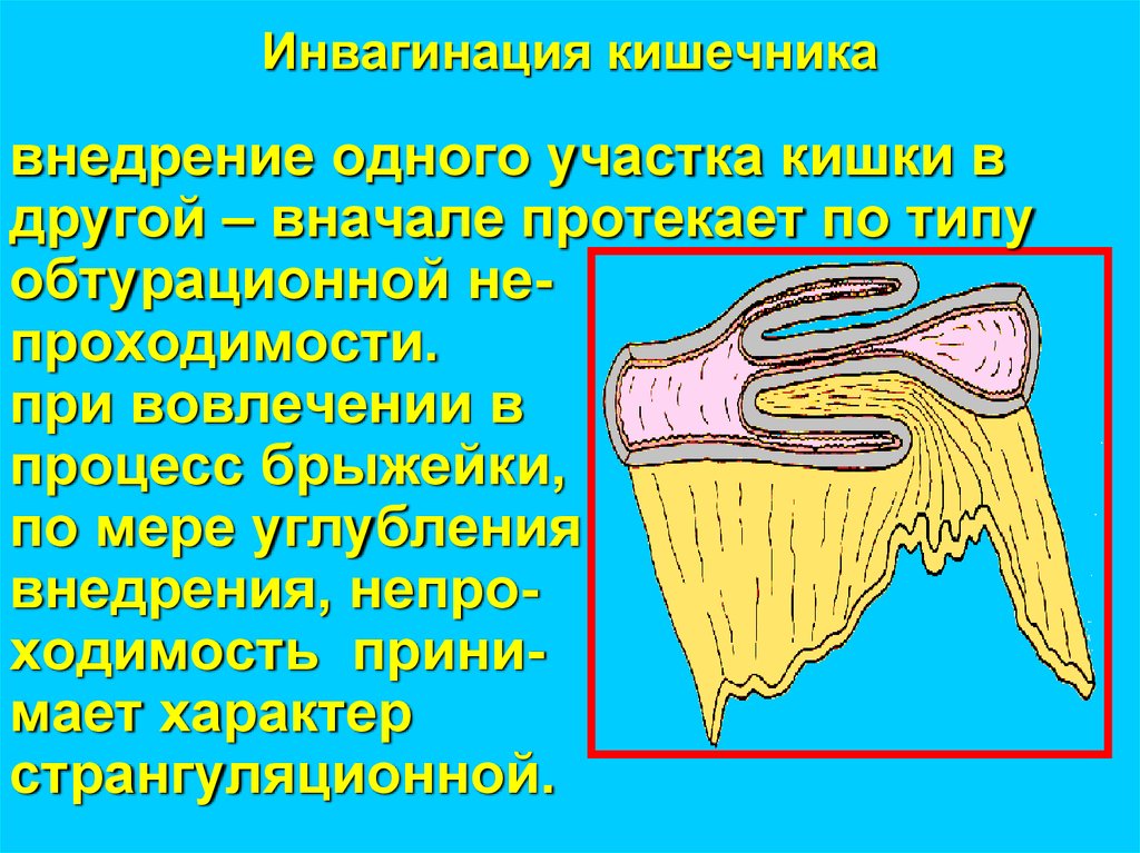 Инвагинация кишечника